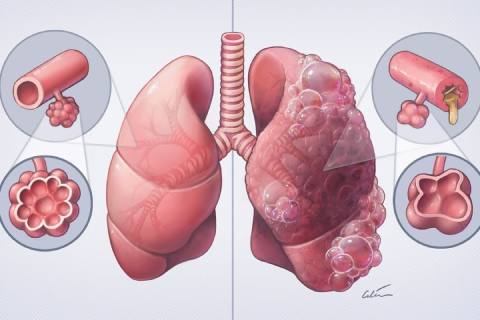 COPD Management